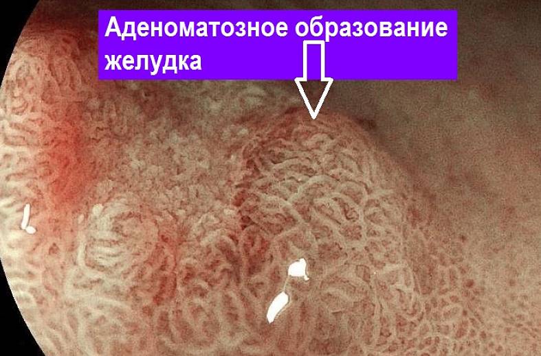 Видеогастроскопия аппаратом expert "PENTAX i7010" экспертного класса