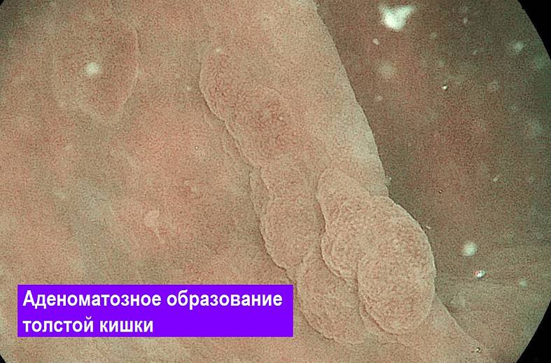 Видеоколоноскопия экспертного класса на аппарате Pentax i7010 (Япония) expert