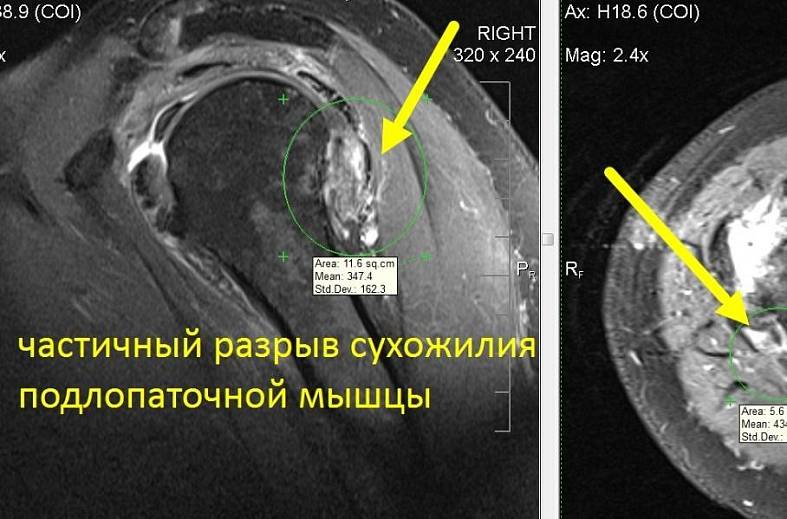 МРТ плечевого сустава
