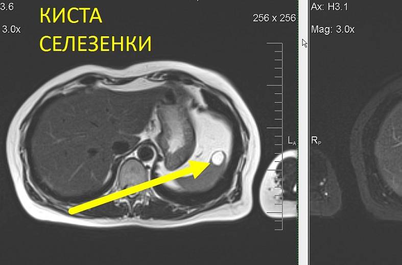 МРТ органов брюшной полости и холангиография (детальный осмотр внутри и вне печеночных желчных протоков)