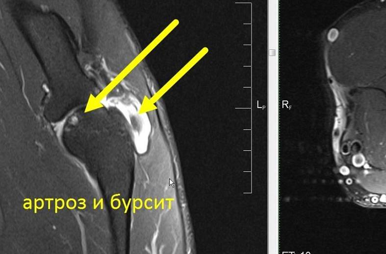 МРТ локтевого сустава