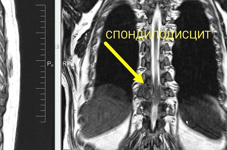 МРТ грудного отдела позвоночника