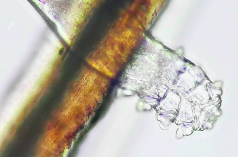 Обследование и забор материала на Демодекоз (Demodex)