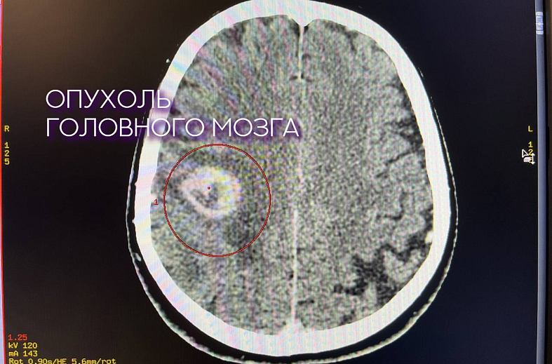 КТ головного мозга