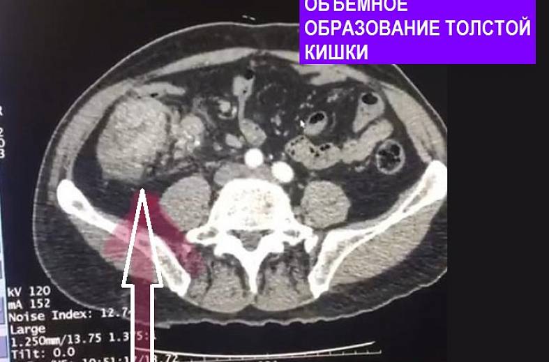 КТ толстой кишки, виртуальная колоноскопия