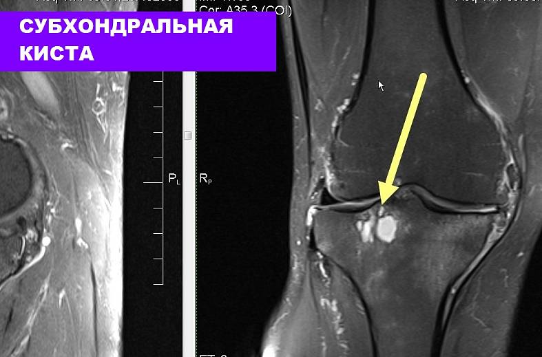 МРТ коленного сустава на 15-канальной катушке