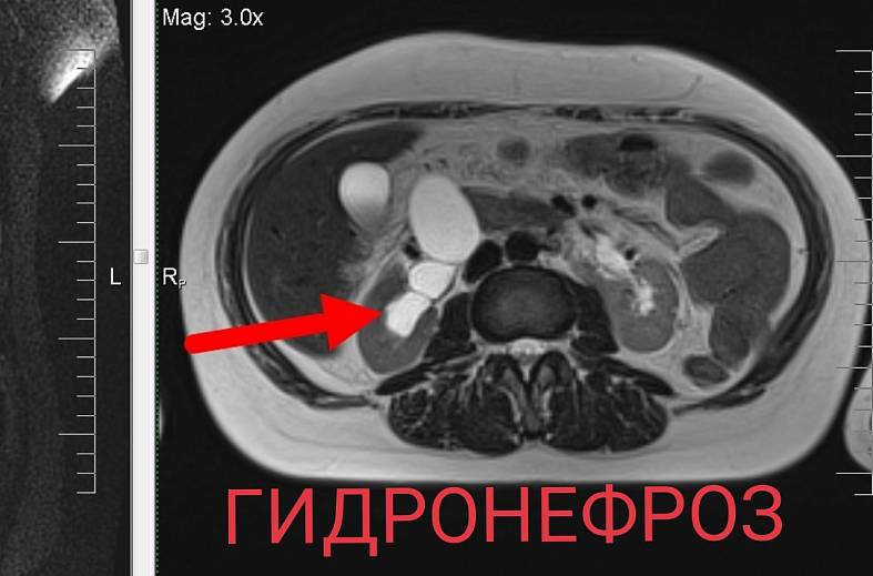 МРТ органов забрюшинного пространства (почки, надпочечники, нижняя полая вена, лимфатические узлы, брюшной отдел аорты)
