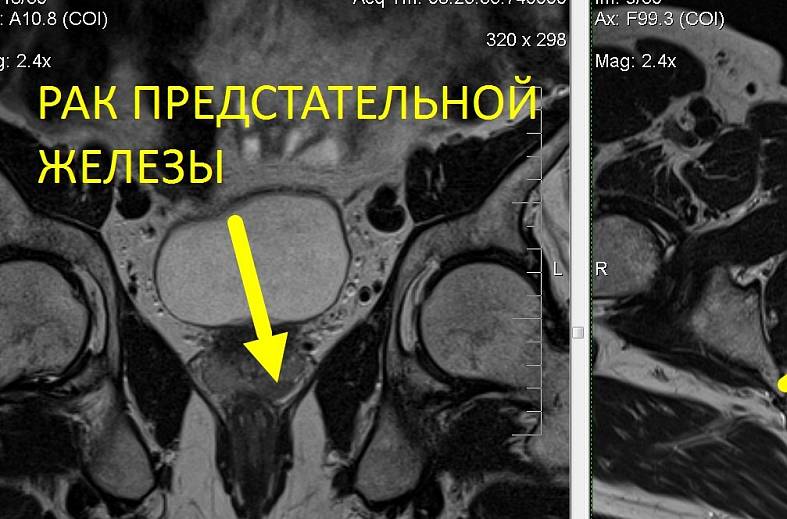 Диффузно-взвешенное магнитно-резонансное изображение (DWI MRI) ( для обеспечивания контрастности картинки)