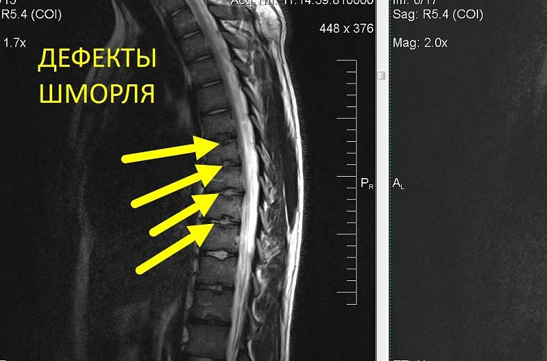 МРТ всего позвоночника (осмотр по ТИМ технологии)