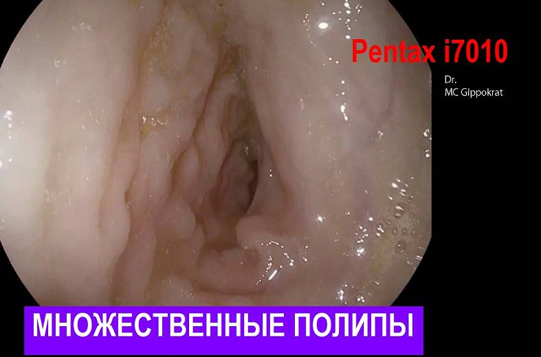 Видеоколоноскопия экспертного класса на аппарате Pentax i7010 (Япония) expert