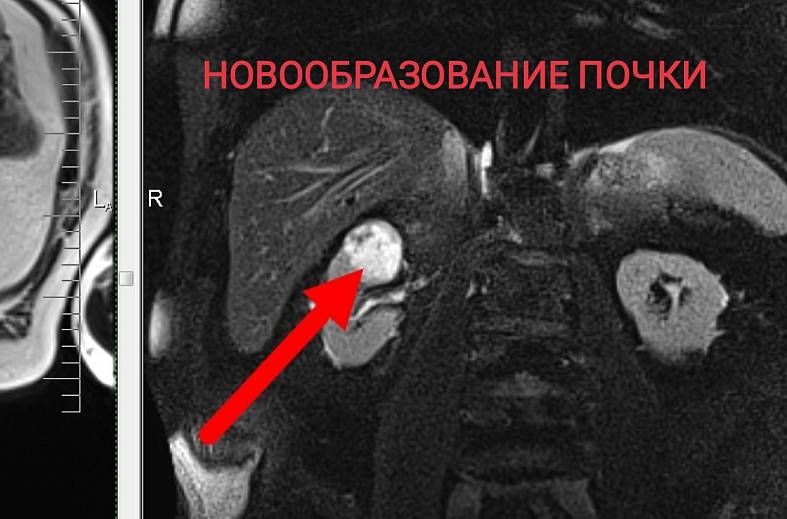 МРТ органов забрюшинного пространства (почки, надпочечники, нижняя полая вена, лимфатические узлы, брюшной отдел аорты)