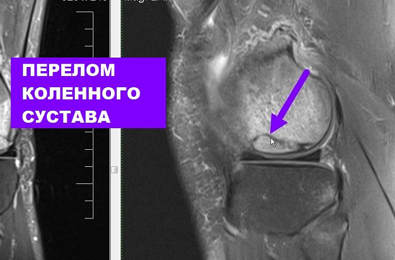 МРТ коленного сустава на 15-канальной катушке