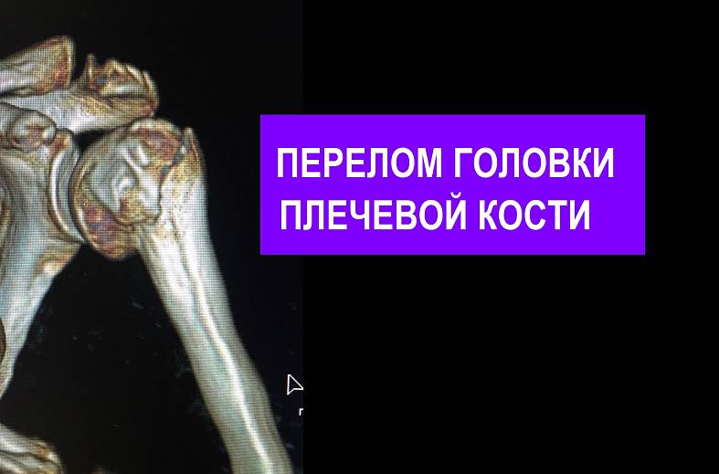 КТ плечевого сустава