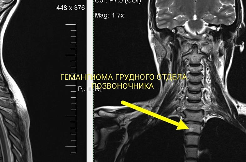 МРТ грудного отдела позвоночника