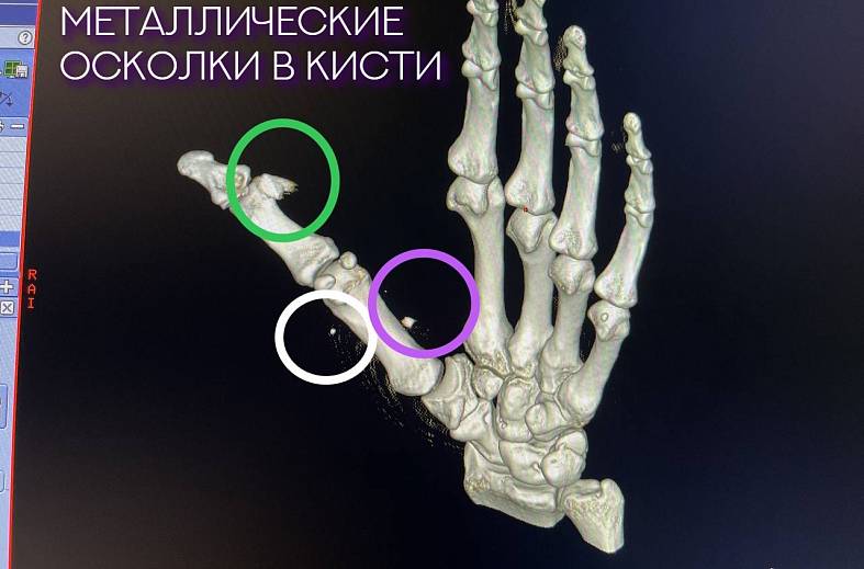 КТ кисти